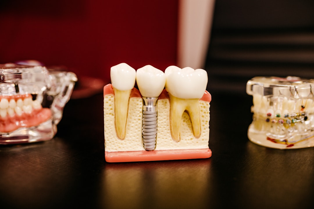 Implante dental con apariencia natural