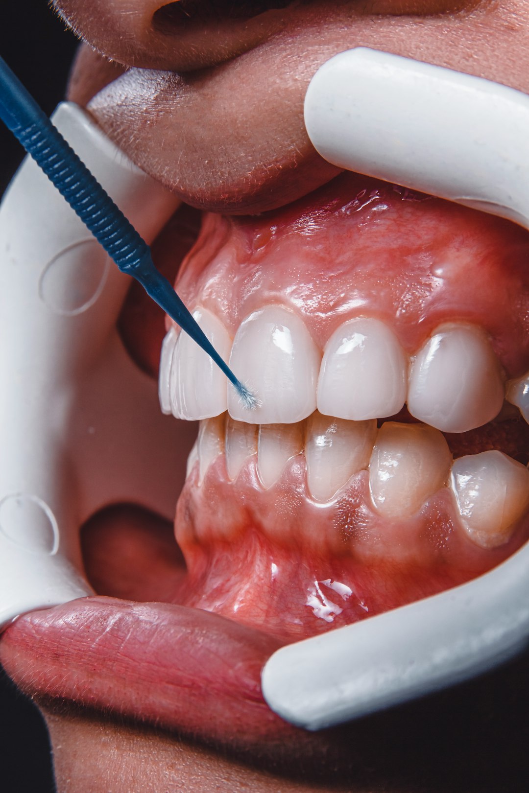 Prótesis dental restauración estética